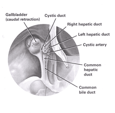 Improper Identification of the Anatomy Around the Gall Bladder